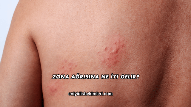 Zona Ağrısına Ne İyi Gelir?