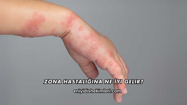 Zona Hastalığına Ne İyi Gelir?