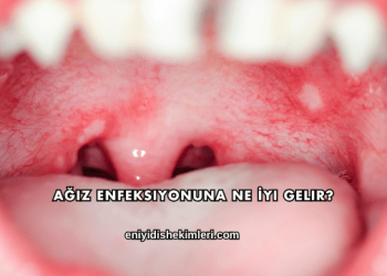 Ağız Enfeksiyonuna Ne İyi Gelir?