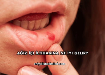 Ağız İçi İltihabına Ne İyi Gelir?