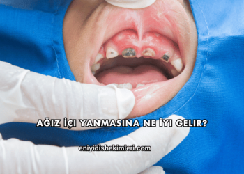 Ağız İçi Yanmasına Ne İyi Gelir?