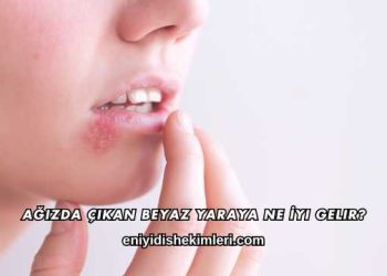 Ağızda Çıkan Beyaz Yaraya Ne İyi Gelir?