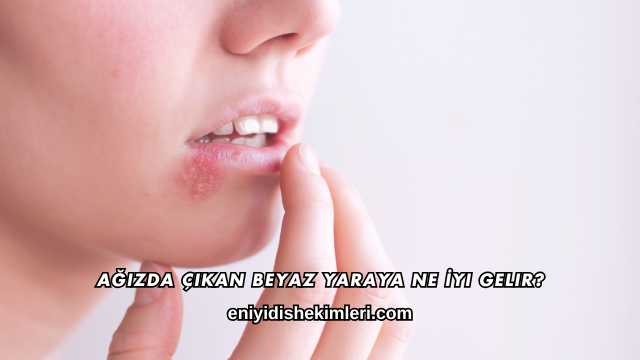 Ağızda Çıkan Beyaz Yaraya Ne İyi Gelir?