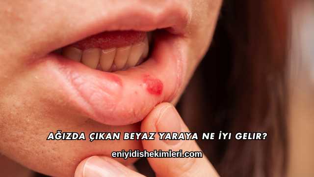 Ağızda Çıkan Beyaz Yaraya Ne İyi Gelir?