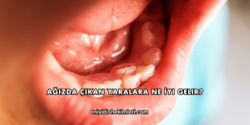 Ağızda Çıkan Yaralara Ne İyi Gelir?