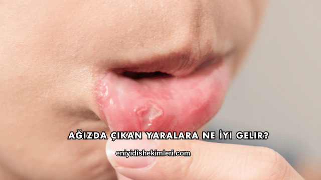 Ağızda Çıkan Yaralara Ne İyi Gelir?