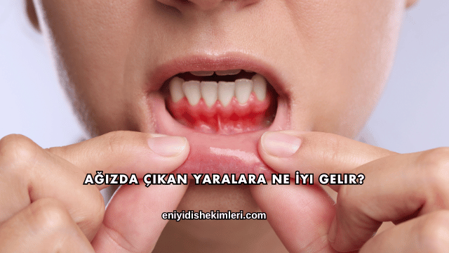 Ağızda Çıkan Yaralara Ne İyi Gelir?