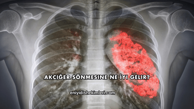 Akciğer Sönmesine Ne İyi Gelir?