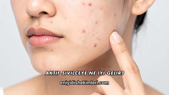 Aktif Sivilceye Ne İyi Gelir?