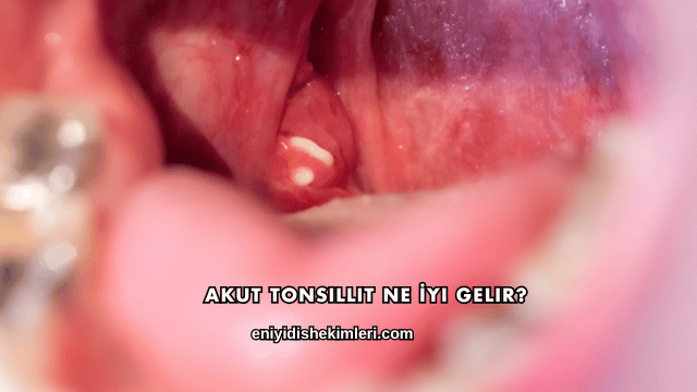 Akut Tonsillit Ne İyi Gelir?