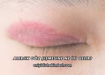 Alerjik Göz Şişmesine Ne İyi Gelir?