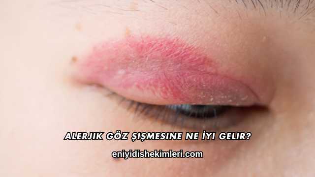 Alerjik Göz Şişmesine Ne İyi Gelir?