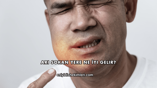 Arı Sokan Yere Ne İyi Gelir?