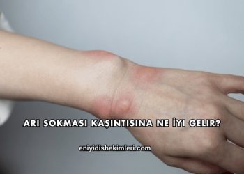 Arı Sokması Kaşıntısına Ne İyi Gelir?