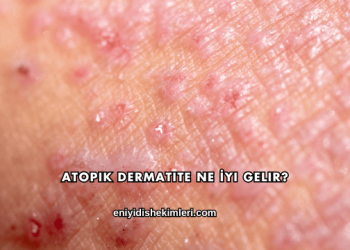 Atopik Dermatite Ne İyi Gelir?