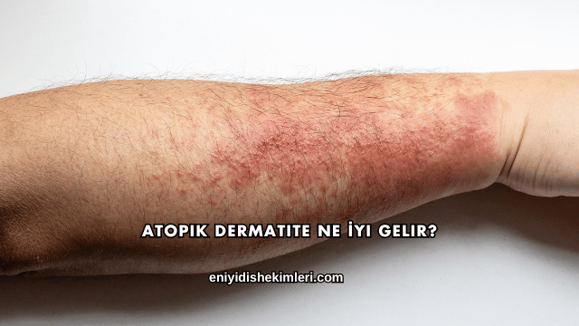 Atopik Dermatite Ne İyi Gelir?