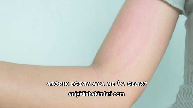 Atopik Egzamaya Ne İyi Gelir?