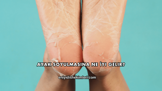Ayak Soyulmasına Ne İyi Gelir?