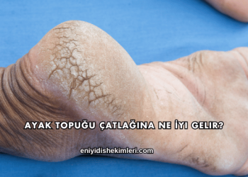 Ayak Topuğu Çatlağına Ne İyi Gelir?