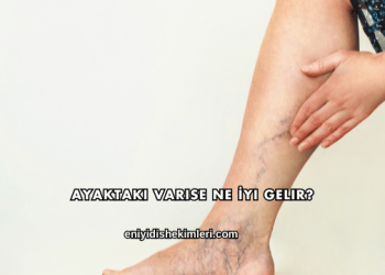 Ayaktaki Varise Ne İyi Gelir?