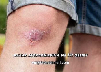 Bacak Morarmasına Ne İyi Gelir?