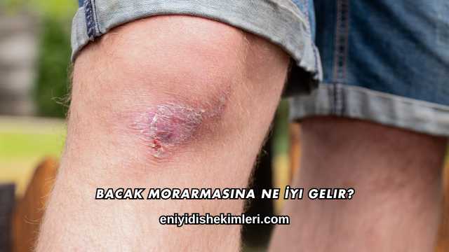 Bacak Morarmasına Ne İyi Gelir?