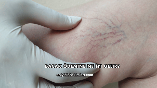Bacak Ödemine Ne İyi Gelir?