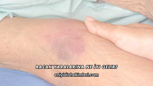 Bacak Yaralarına Ne İyi Gelir?