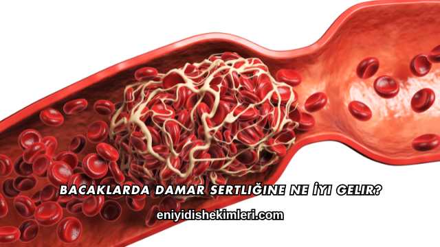 Bacaklarda Damar Sertliğine Ne İyi Gelir?