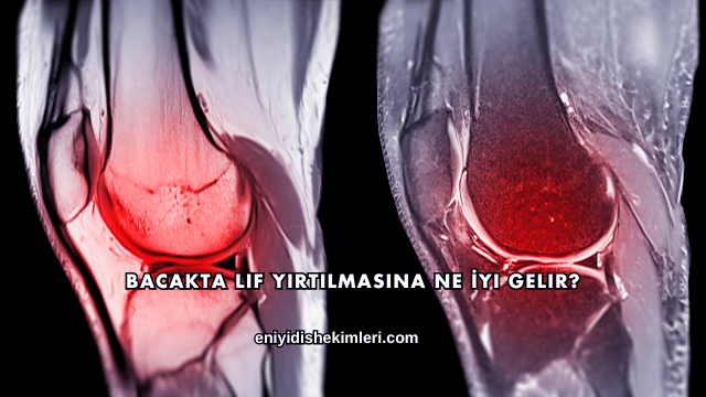 Bacakta Lif Yırtılmasına Ne İyi Gelir?