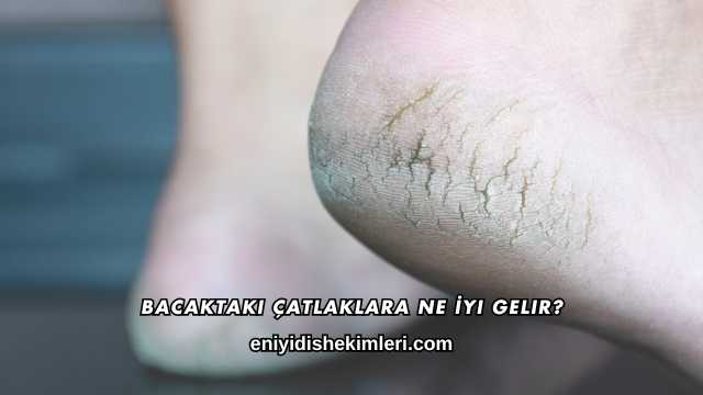 Bacaktaki Çatlaklara Ne İyi Gelir?