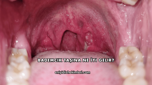 Bademcik Taşına Ne İyi Gelir?