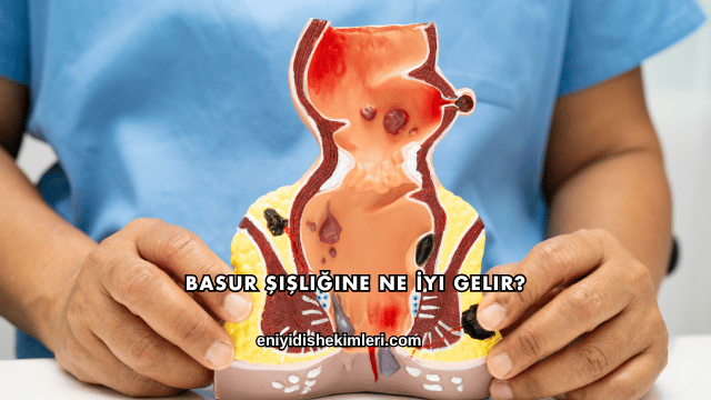 Basur Şişliğine Ne İyi Gelir?