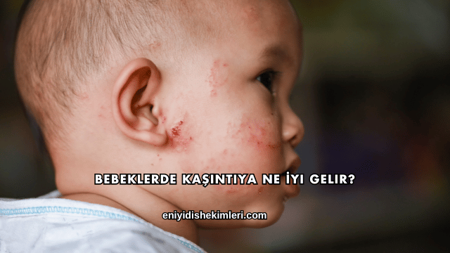 Bebeklerde Kaşıntıya Ne İyi Gelir?