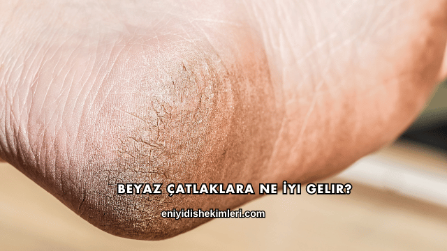 Beyaz Çatlaklara Ne İyi Gelir?