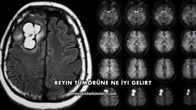 Beyin Tümörüne Ne İyi Gelir?