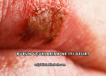 Burun Uçuklarına Ne İyi Gelir?