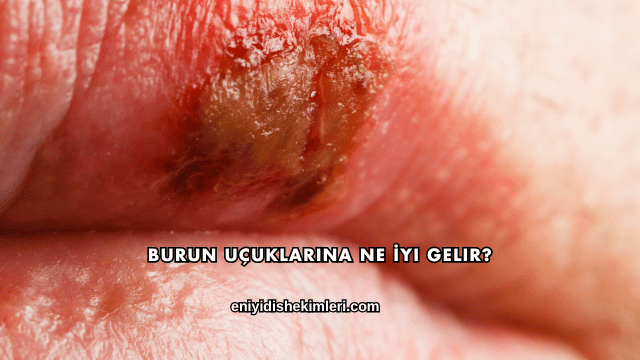 Burun Uçuklarına Ne İyi Gelir?