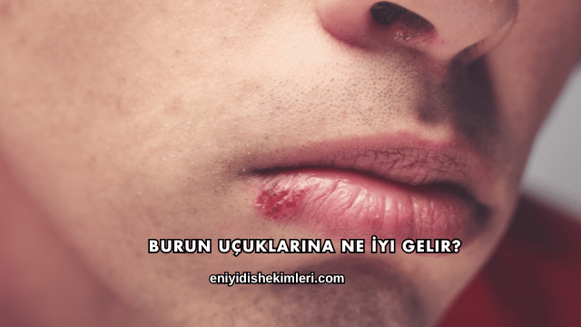 Burun Uçuklarına Ne İyi Gelir?