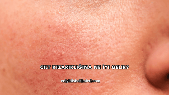 Cilt Kızarıklığına Ne İyi Gelir?