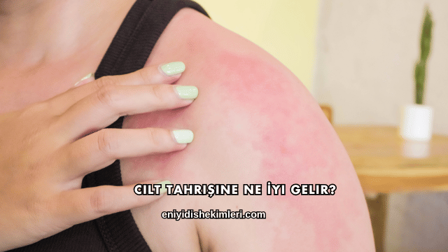 Cilt Tahrişine Ne İyi Gelir?