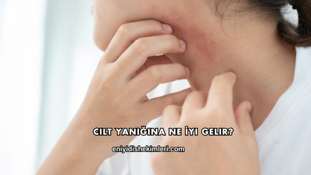 Cilt Yanığına Ne İyi Gelir?