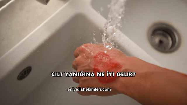 Cilt Yanığına Ne İyi Gelir?