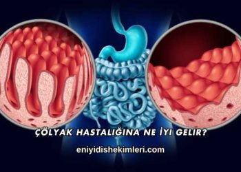 Çölyak Hastalığına Ne İyi Gelir?