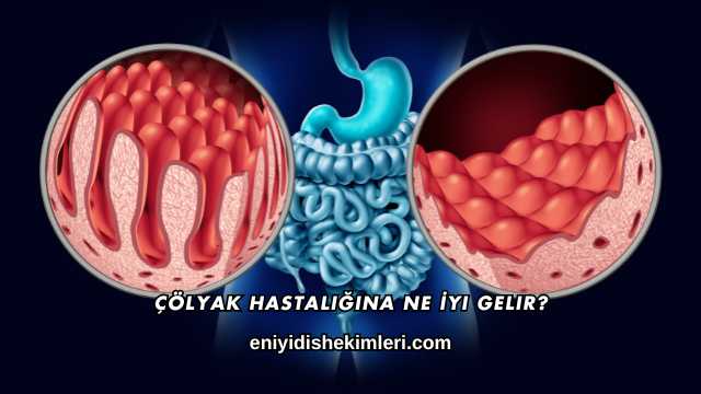 Çölyak Hastalığına Ne İyi Gelir?