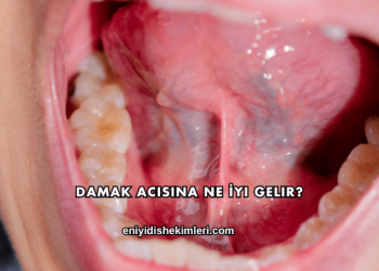 Damak Acısına Ne İyi Gelir?