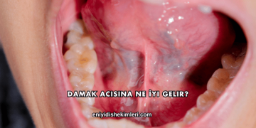Damak Acısına Ne İyi Gelir?