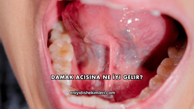 Damak Acısına Ne İyi Gelir?