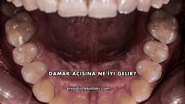 Damak Acısına Ne İyi Gelir?