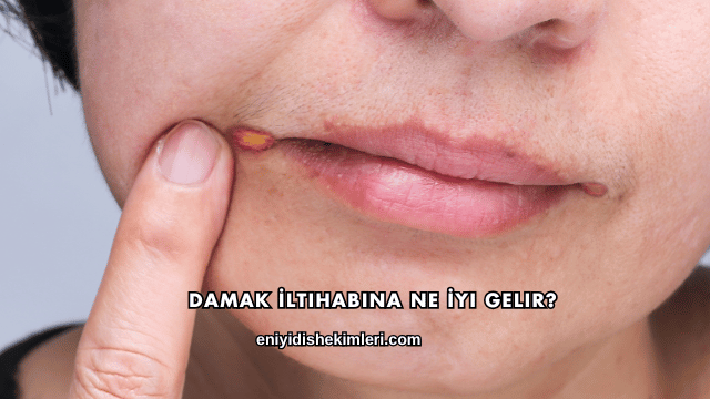 Damak İltihabına Ne İyi Gelir?